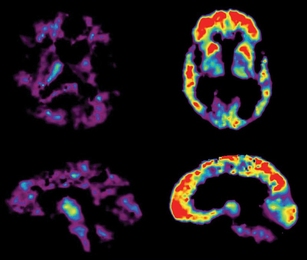 PET Scans Showing PiB Uptake in the brain of a cognitively healthy person (left) and in the brain of a person with AD (right).