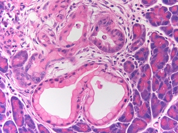 Seen here are two clusters of precancerous cells (lower half of image), which arose in pancreatic cells expressing the pdx1 protein and the cancer gene K-ras.