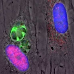 This image shows two human skin cells. The cell at left is infected with the Toxoplasma gondii parasite expressing type II GRA15, which can be seen in green. The cell on the right (with a blue nucleus) is not infected. The nucleus of the infected cell contains many copies of the NF-kB transcription factor (shown in pink).