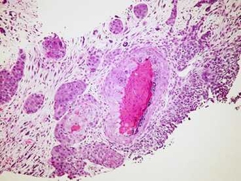 Lung cancer cells as seen under a microscope.