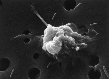 An image of a cancer cell undergoing apoptosis (cell death).