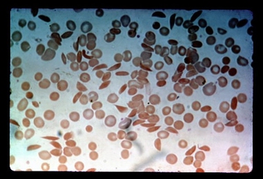 Researchers from MIT, Harvard, MGH and Brigham and Women's Hospital have developed a microfluidic device that can analyze the behavior of blood samples from sickle cell disease patients, which usually include many crescent-shaped cells.