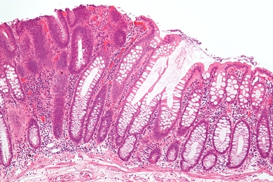 This micrograph shows a colorectal adenoma, a benign form of cancer that can turn malignant.