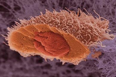 A scanning electron micrograph of a squamous cell carcinoma, a type of skin cancer. The cell has been frozen and split open to reveal its nucleus.