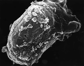 Scanning electron microscope image of a lymphocyte with HIV cluster.