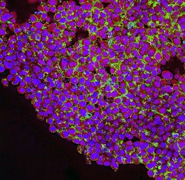 Human breast cancer cells (purple) are targeted by nanoparticles (green) developed by MIT professor Paula Hammond. The particles bind to receptors overexpressed by cancer cells.