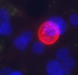 <i>Plasmodium vivax</i> (red sphere) grows in engineered liver tissue developed by MIT researchers to study malaria. The blue spheres represent the nuclei of cells that make up the microscale liver tissue.
