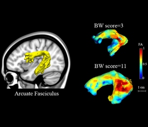 On the left, the arcuate fasciculus is highlighted in the brain. On the right, the colors of the arcuate fasciculus indicate the level of randomness of water diffusion within the structure, which reflects the integrity of white matter tracts and fiber organization. Higher fractional anisotropy (FA) scores indicate higher tract integrity. The MIT team found that those values correlated with scores ...
