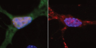 At left, a neuron exhibits normal DNA repair, indicated by green fluorescence. At right, a neuron with a mutated form of the FUS protein found in ALS patients shows very little DNA repair. 
