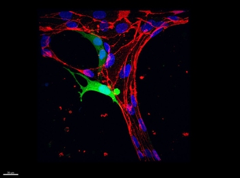 A tumor cell (green) pushes halfway through a blood vessel (red).