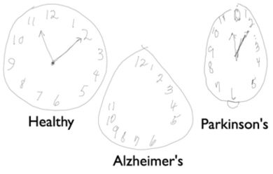 Coupled with a digital pen, new models from the MIT Computer Science and Artificial Intelligence Lab can help detect dementia and other cognitive disorders earlier than ever before.