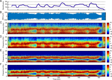 Using a novel analytical method they have developed, MIT researchers analyzed raw brain activity data (B). The spectrogram shows decreased noise and increased frequency resolution, or contrast (E and F) compared to standard spectral analysis methods (C and D). 