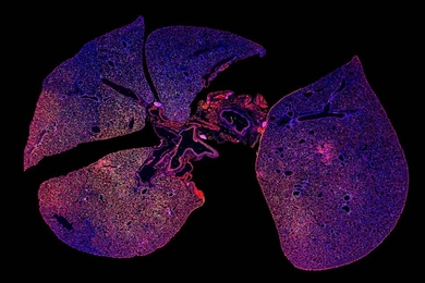 A strong immune response can be seen in this immunofluorescence image of lung tissue infected with pneumonia where immune cells are stained green and red.