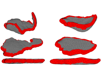 An algorithm developed at MIT takes MRI images of placentas (top) and flattens them to be more easily analyzed (middle and bottom).