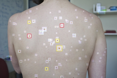 Digitized photo of a person's unclothed back, showing dozens of spots on the skin, each surrounded by a computer-graphic square of a different color