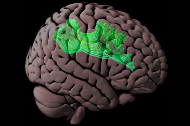 Image of human brain with white matter tracts highlighted in green