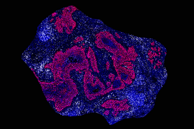 An irregular, oblong-shaped tumor, with patches of cells in magenta or deep blue on a black background. The blue areas are speckled with white dots; the magenta areas are not.