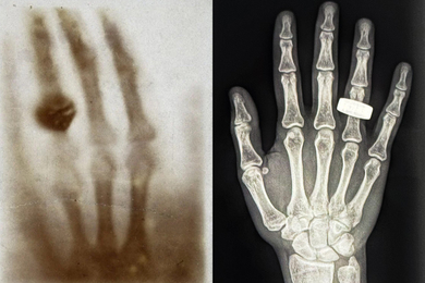 Two images show x-rays of a hand with a ring.