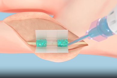 Rendering showing adhesive being applied to a flesh wound