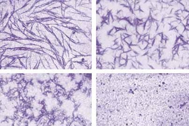 In the upper left, amyloid fibers at first resist any attempt to disrupt their structure. Hsp104, however, breaks them apart until, bottom right, they have been completely dissolved.