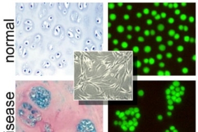 Cells are organized differently in normal and diseased cartilage (left). Now these changes can be made and studied in the lab. Here, 3-D cell clusters are precisely re-created in a tissuelike gel (right). The same cells in a conventional 2-D Petri dish look and behave much differently (inset).