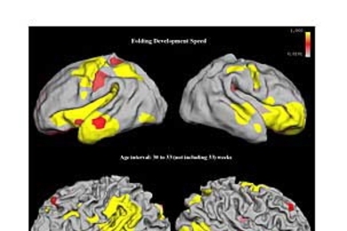 Larger-scale folds develop the fastest in premature (born more than seven weeks early) infants (top), while medium-scale folds develop the fastest in older premature infants, born between seven and two weeks early (middle). In older infants and children, fine folds develop the most quickly across the brain surface (bottom).