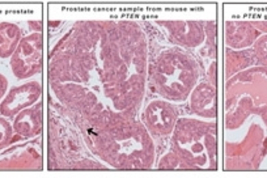 The image on the left shows a sample from a normal prostate, with organized cells lining the O-shaped ductules.  Mice without the PTEN gene had developed cancer, which is characterized by enlarged glands and disorganized cells clogging the ductules (middle image).  When mTORC2 activity is blocked in mice lacking the PTEN gene, the prostate ductules resemble the appearance of norm...