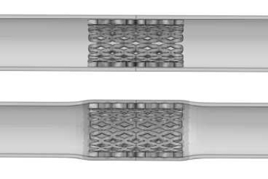 A computer simulation based on the numerical modeling carried out by Vikas Srivastava, Shawn Chester and Lallit Anand shows how a stent made of shape-memory polymer would look as it undergoes a transition inside the body from a compressed shape, used for inserting it into position, to its fully extended original shape.