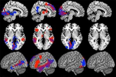 In these fMRI brain scans, regions that are active during language processing tasks appear as red or blue (for two different types of tasks.)  Parts of the left visual cortex are active in blind participants, but not sighted participants.