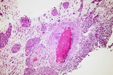 Lung cancer cells as seen under a microscope.