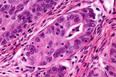 A microscopy image of an ovarian adenocarcinoma. MIT researchers have found a new way to disrupt a protein often overexpressed in ovarian tumors, known as HER3.