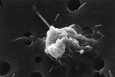 An image of a cancer cell undergoing apoptosis (cell death).