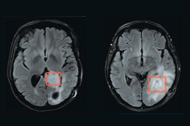 Using MR spectroscopy, a team of researchers has developed a way to measure whether brain tumors have a mutation in a gene called IDH. The tissue being analyzed is inside the red boxes. The tumor on the left has the mutation, while the tumor on the right does not.