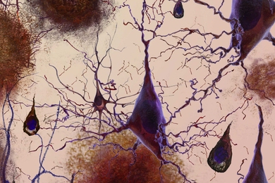 An artist's rendering of the loss of connections between neuron cells.