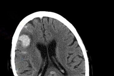 MIT researchers have developed a way to monitor pressure inside the brains of patients with injuries such as the bleeding seen in this CT scan.