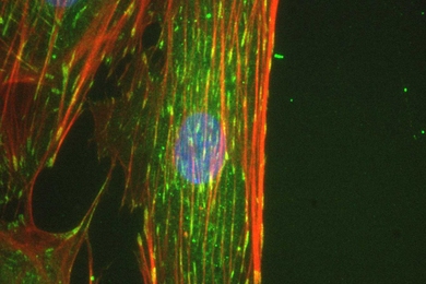 Proteins (actin, red and vinculin, green) inside adult bone marrow-derived stem cells that were grown in the lab for three days, with (top image) and without (bottom) the 'crowder' particles. Cells grown with the crowders form neatly aligned structures, or matrices, outside the cell, which in turn align their internal actin networks; the structures both outside and inside the cells grown without t...