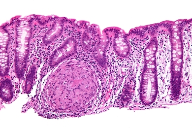 Endoscopic biopsy showing granulomatous inflammation of the colon in a case of Crohn's disease.