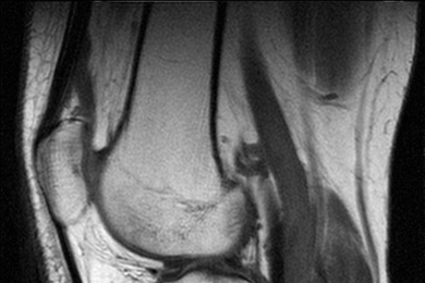 A sagittal MRI of the knee