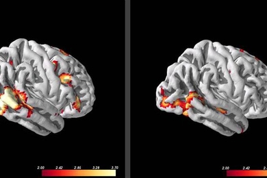 Social anxiety patients with more activity in visual processing areas, left, when viewing images of angry faces, responded better to subsequent cognitive behavioral therapy than patients with lower activity in those regions.