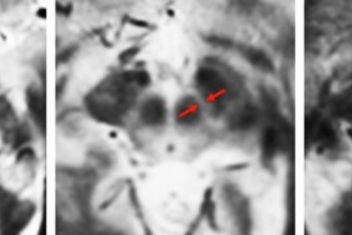 MIT neuroscientists imaged the substantia nigra in a young adult, left, an older adult, center, and a Parkinson’s patient, right. They found that the substantia nigra deteriorates in Parkinson’s patients.