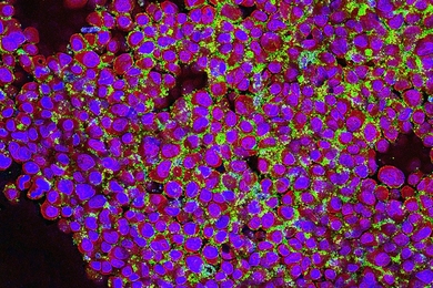 Human breast cancer cells (purple) are targeted by nanoparticles (green) developed by MIT professor Paula Hammond. The particles bind to receptors overexpressed by cancer cells.