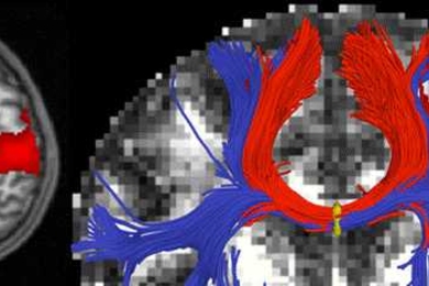 A functional MRI (fMRI), seen at left, can identify regions where blood flow increases in the brain during particular cognitive tasks. A diffusion MRI, seen at right, can identify the white matter that carries information between regions of the brain.