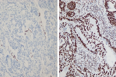 MIT researchers discovered that certain genes in endometrial cancer are inactivated in only some parts of the tumor. Tumor suppressor ARID1A is expressed in the primary tumor (left, brown staining) but not in its paired metastasis (right). 