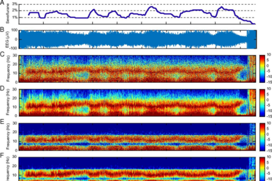 Using a novel analytical method they have developed, MIT researchers analyzed raw brain activity data (B). The spectrogram shows decreased noise and increased frequency resolution, or contrast (E and F) compared to standard spectral analysis methods (C and D). 