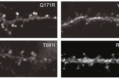 Some variants of the SYNE1 gene, such as V551A top right, reduced the ability of the protein CPG2, shown here as bright spots, to locate in protruding spines of dendrites that house excitatory synapses in the neurons of rats.