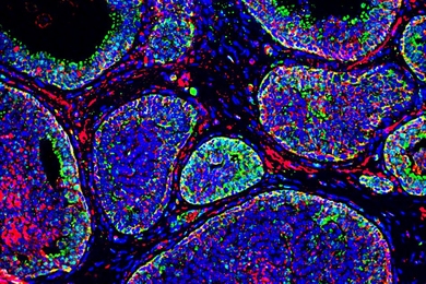 In these tumor cells, acidic regions are labeled in red. Invasive regions of the cells, which express a protein called MMP14, are labeled in green.