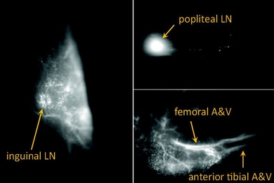 A bright fluorescent quantum defect can be a tool to upgrade current biomedical imaging systems, looking at even smaller tumors through the defect emission.