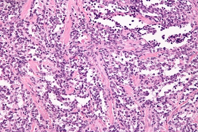 Alveolar rhabomyosarcoma, a soft tissue cancer
