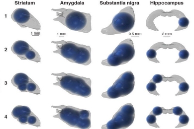 3D renderings of simulated multi-bolus delivery to various brain structures (striatum, amygdala, substantia nigra, and hippocampus) show one to four boluses.