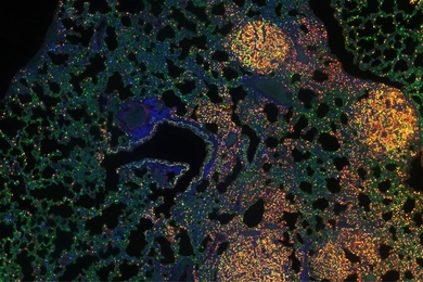 MIT researchers have analyzed how epigenomic modifications change as tumors evolve. This image shows a lung with tumors that researchers collected with multiplexed immunohistochemistry.